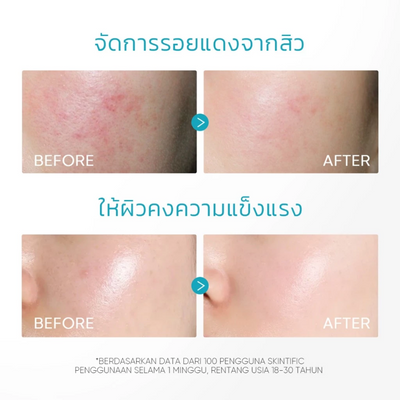 Non-comedogenic acne hydrator