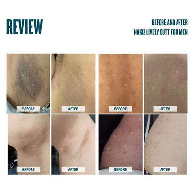 Skin care cream for knees, elbows, buttocks