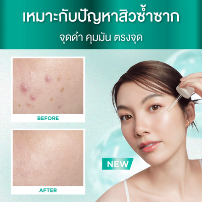 Before and after comparison of using Smooth E PHA-AHA Acne Spot and Pore Smooth with a woman on a teal background.