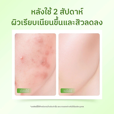 Acne B5 serum for breakouts