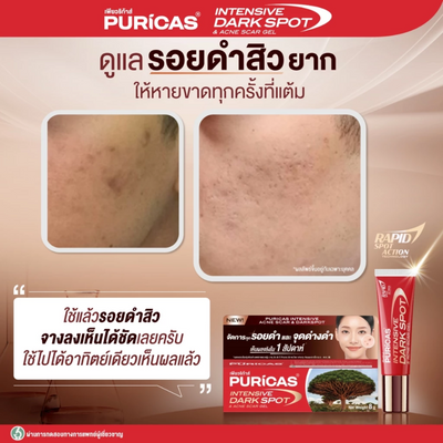 Puricas Intensive Dark Spot Gel for acne scars