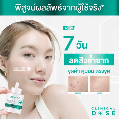 Woman holding a Smooth E PHA-AHA Acne Spot and Pore Smooth Serum with before Vs after effects on skin shown, against a white background.
